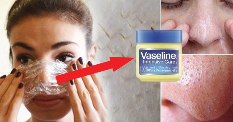 แชร์เก็บไว้เลย..!! สูตรลอกสิวเสี้ยนแบบบ้านๆ ด้วยวาสลีน (Vaseline) เพื่อจมูกสวยใสกิ๊ก!! ไม่น่าเชื่อ ได้ผลดีเกินคาด !!