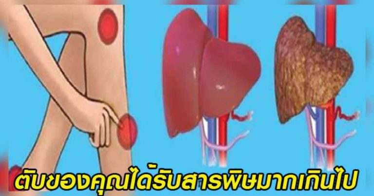 สัญญาณเตือนแบบนี้..บ่งบอกว่าตับของคุณได้รับสารพิษที่มากเกินไปแล้ว