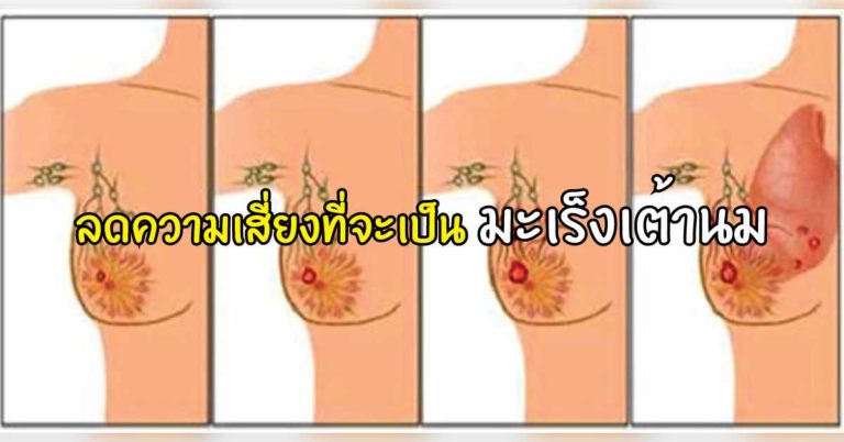 หญิงควรอ่าน แนะนำ 6 วิธีการลดความเสี่ยงที่จะเป็นมะเร็งเต้านม