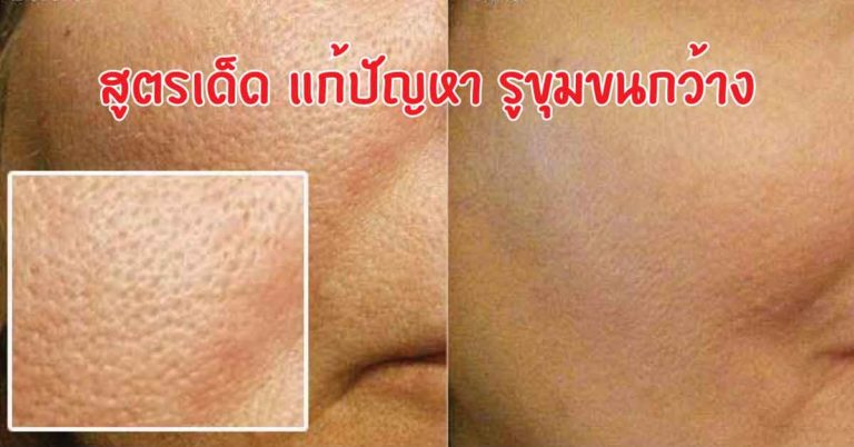 สูตรเด็ด แก้ปัญหา รูขุมขนกว้าง กลับมาสวยใส ง่ายนิดเดียว