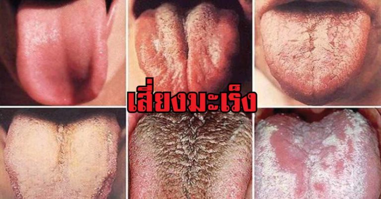 เคยสังเกตุไหม? สีของลิ้นคุณสามารถบอกโรคที่คุณเป็นได้นะ มาเช็คกันเลย