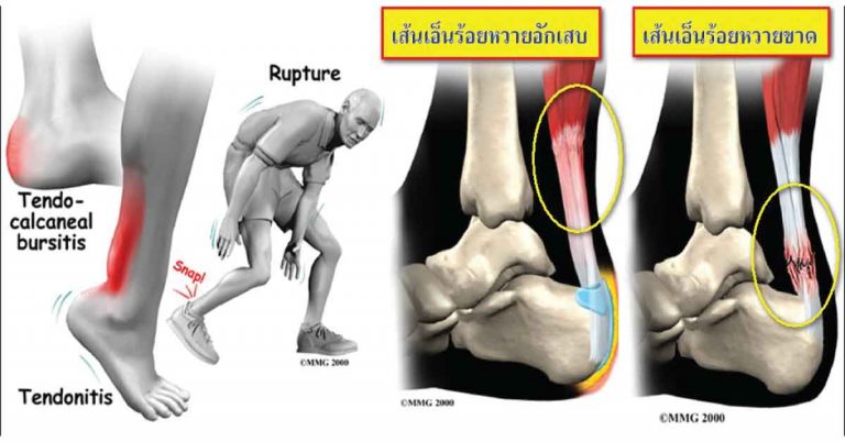 แพทย์เผย! ปวดหัวเข่า ปวดข้อ ข้อเข่าเสื่อม.. รักษาได้ไม่ยาก