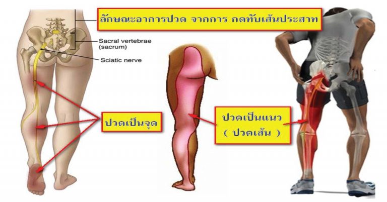 เป็นเรื่องใกล้ตัวมากๆ ถ้าใครมีอาการปวดแบบนี้ ให้รีบไปพบแพทย์ด่วนเลย!