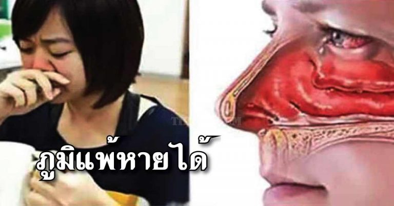 ภูมิแพ้หายได้ เคล็ดลับกำจัดอาการภูมิแพ้ด้วย 4 อาหารใกล้ตัว