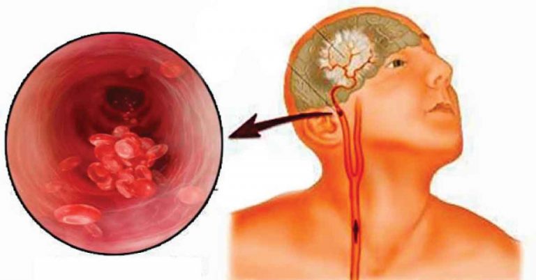 คุณอาจช่วยชีวิตคนได้ “วิธีการเช็คเส้นเลือดอุดตันในสมอง” เพียงแค่ทำแบบนี้!