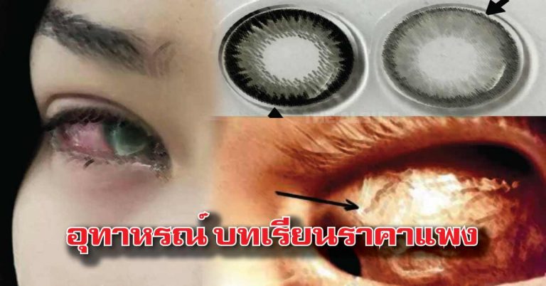 อุทาหรณ์สอนใจ บทเรียนราคาแพงกับคอนแทคเลนส์ แชร์บอกต่อ