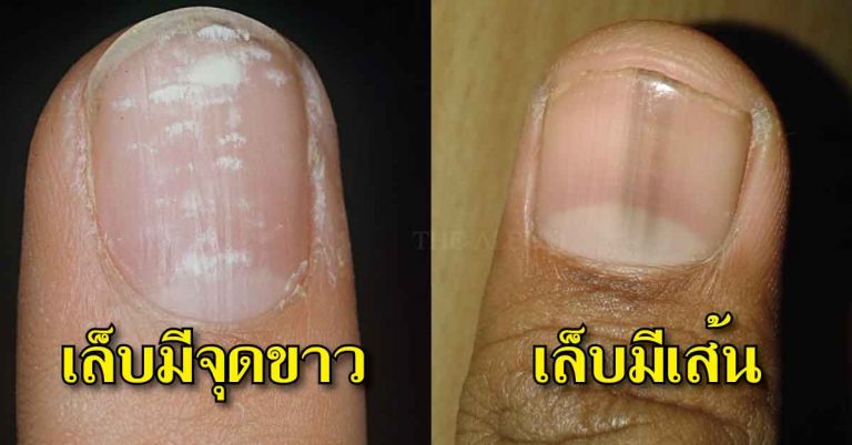 สัญญาอันตราย!! อาการนี้ของ ‘เล็บ’ อย่ามองข้าม มันกำลังเตือนคุณเรื่องสุขภาพ