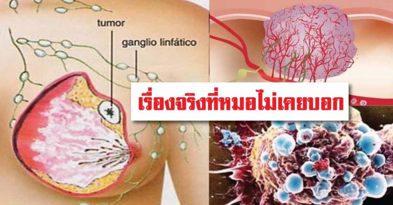 มะเร็งแพ้อะไร เรื่องจริงที่ต้องรู้ อยากเอาชนะมะเร็งต้องทำอย่างไร ลองอ่านดู