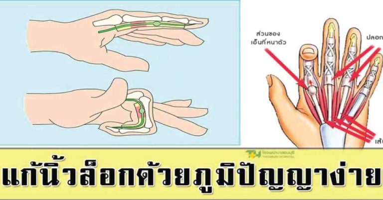 วิธีแก้นิ้วล็อก หินปูนที่ข้อกระดูก ด้วยภูมิปัญญาง่ายๆ