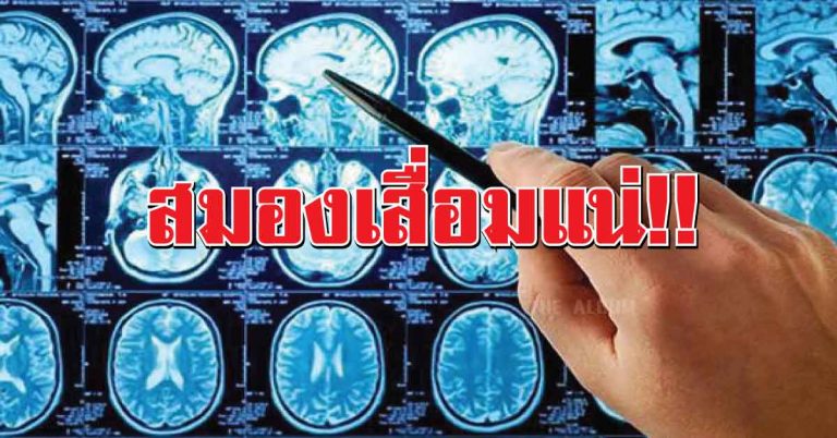 10 นิสัย ทำลายสมอง ใครทำเกิน 5 ข้อนี้ เตรียมเป็นโรคสมองเสื่อมได้เลย