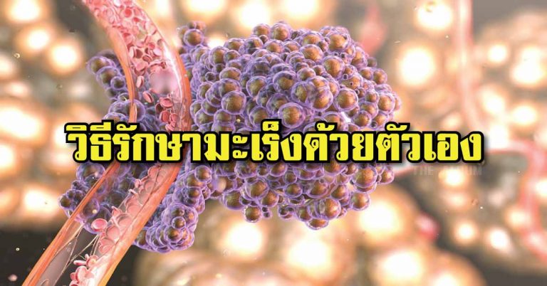 แชร์ต่อ.. บอกบุญ สุดยอดวิธีรักษามะเร็งด้วยตนเอง พร้อมวิธีป้องกันสำหรับคนที่ยังไม่ป่วยหรือมีความเสี่ยง