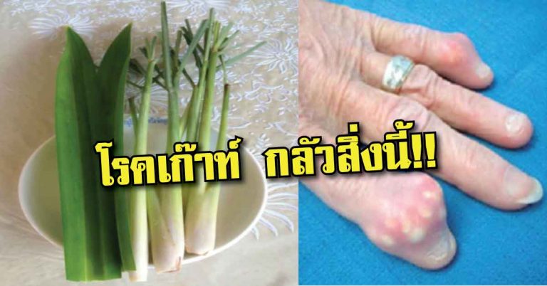 ไม่ต้องทรมาน! โรคเก๊าท์ จะหายเป็นปลิดทิ้ง แค่ใช้สมุนไพรสูตรนี้ ทำกินเองได้