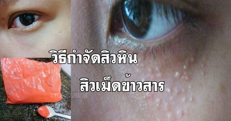 ลองเลย! วิธีกำจัดสิวหิน-สิวเม็ดข้าวสาร แบบง่ายๆ ด้วยปูนแดง!!