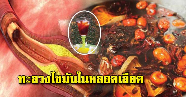 สูตรเด็ด “น้ำสมุนไพรสามสหาย” ทะลวงไขมันในหลอดเลือด​ แชร์เก็บไว้ทำเลย