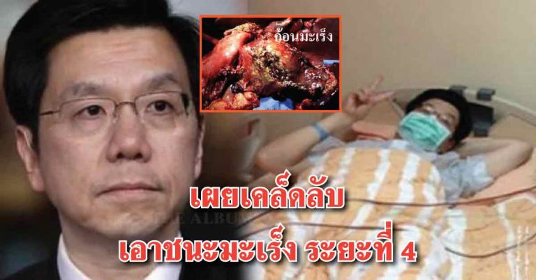 ชาย 52 ปี เอาชนะ “มะเร็งระยะที่ 4” จนสื่อและผู้คนสงสัยกันมาก ในที่สุดเขาต้องออกมาเปิดเผยเคล็ดลับ