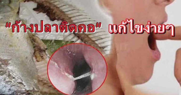 แชร์เก็บไว้เลย!! 4 วิธี แก้ปัญหาก้างปลาติดคอ หลุดออกง่ายๆ ได้ผลชัวร์