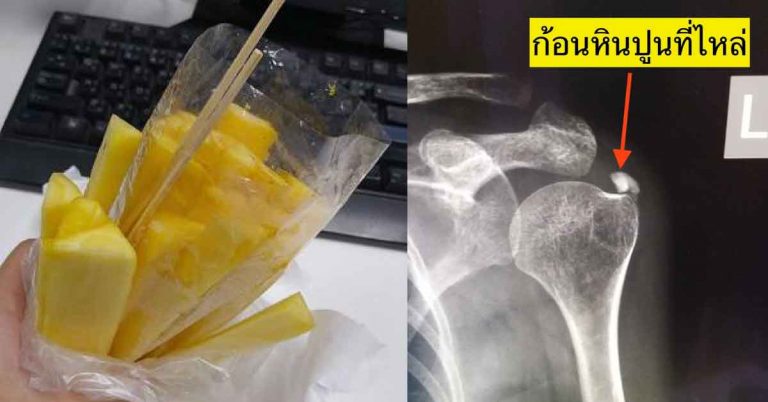 ใครปวดเมื่อย ให้ทำน้ำแกนสับปะรด+ใบโหระพา แก้ “หินปูนเกาะ”