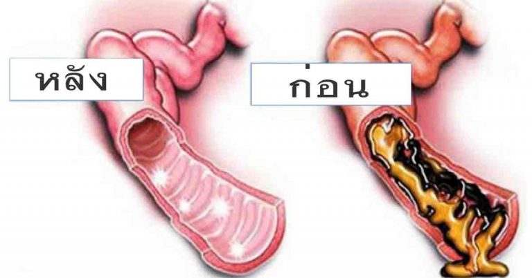 สูตรล้างไขมันลำไส้ ล้างพิษในลำไส้ให้สะอาด สุขภาพดีขึ้น