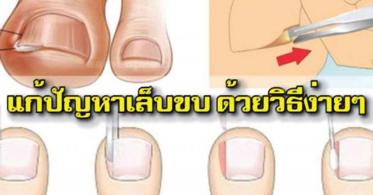 การรักษา เล็บขบ-เป็นหนอง วิธีง่ายๆที่ทำด้วยตัวเอง ทำเลยไม่เจ็บแน่นอน