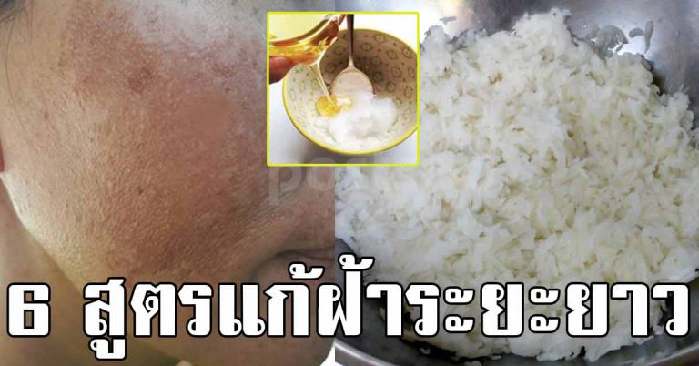 6 วิธี รักษาฝ้า ด้วยสูตรธรรมชาติ ผิวหน้าดีขึ้น ฝ้าจางลงเห็นผลจริง