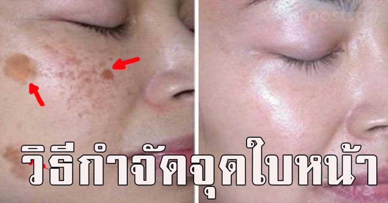 เก็บไว้ทำ วิธีลบจุดต่างๆ บนใบหน้า ผิวหน้าขาวขึ้นในเวลาเพียง 3 คืน