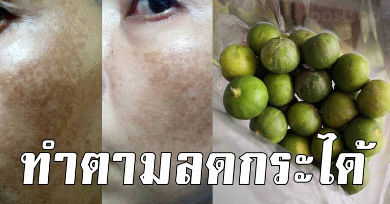 หน้าเนียนกริ๊บ หน้าขาว 10 สูตรลดรอยสิว จุดด่างดํา จุดบนหน้า