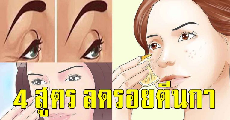 สอนทำเคล็ดลับ 4 ข้อช่วยลดรอยได้ดี รอยหายหมดเกลี้ยง 1 สัปดาห์