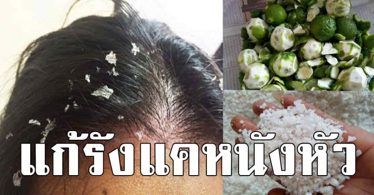 10 สูตร แก้รังแค แบบธรรมชาติ ดีต่อเส้นผมและหนังศีรษะ